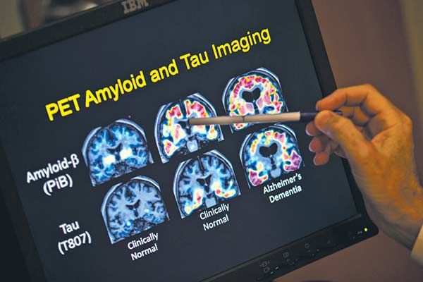 Doctor explaining a brain scan on a monitor